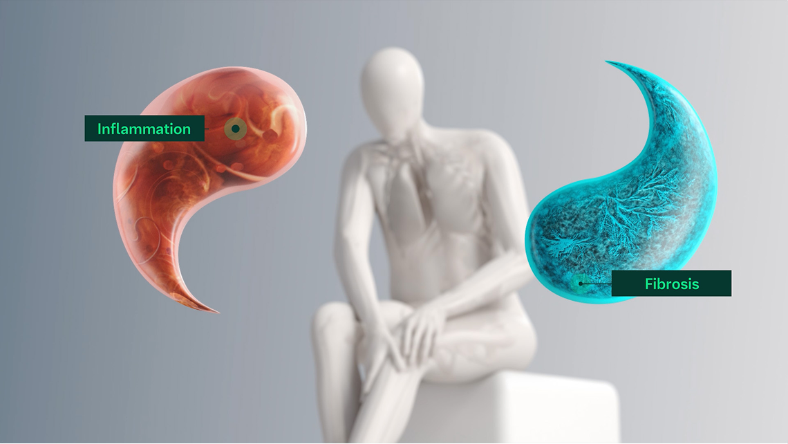 Pathogenesis of autoimmune disease-related ILDs video
