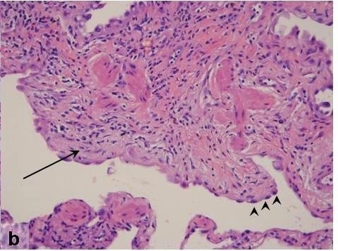 Histopathologic features of usual interstitial pneumonia