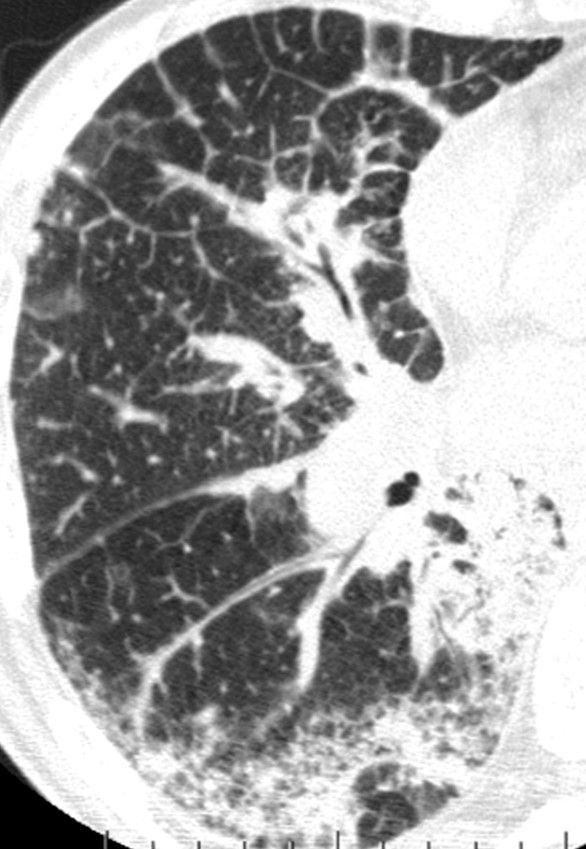 Peribronchovascular predominance