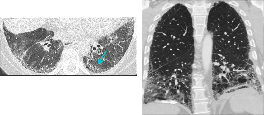 Reticulation HRCT Example