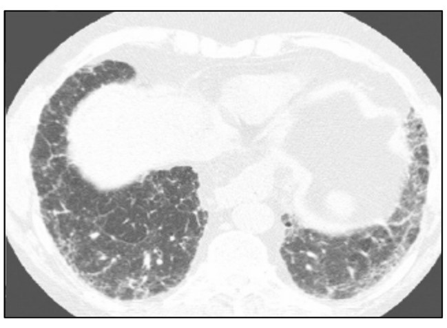 PROBABLE UIP PATTERN