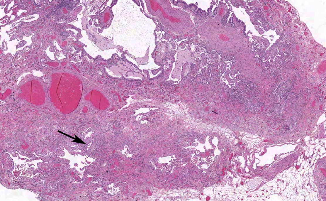 histopathology uip pattern