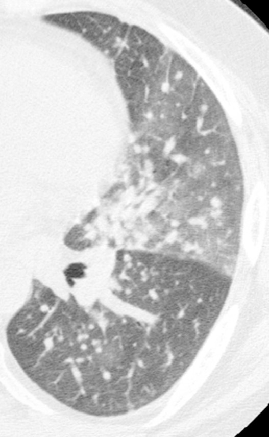 Profuse perilymphatic micronodules