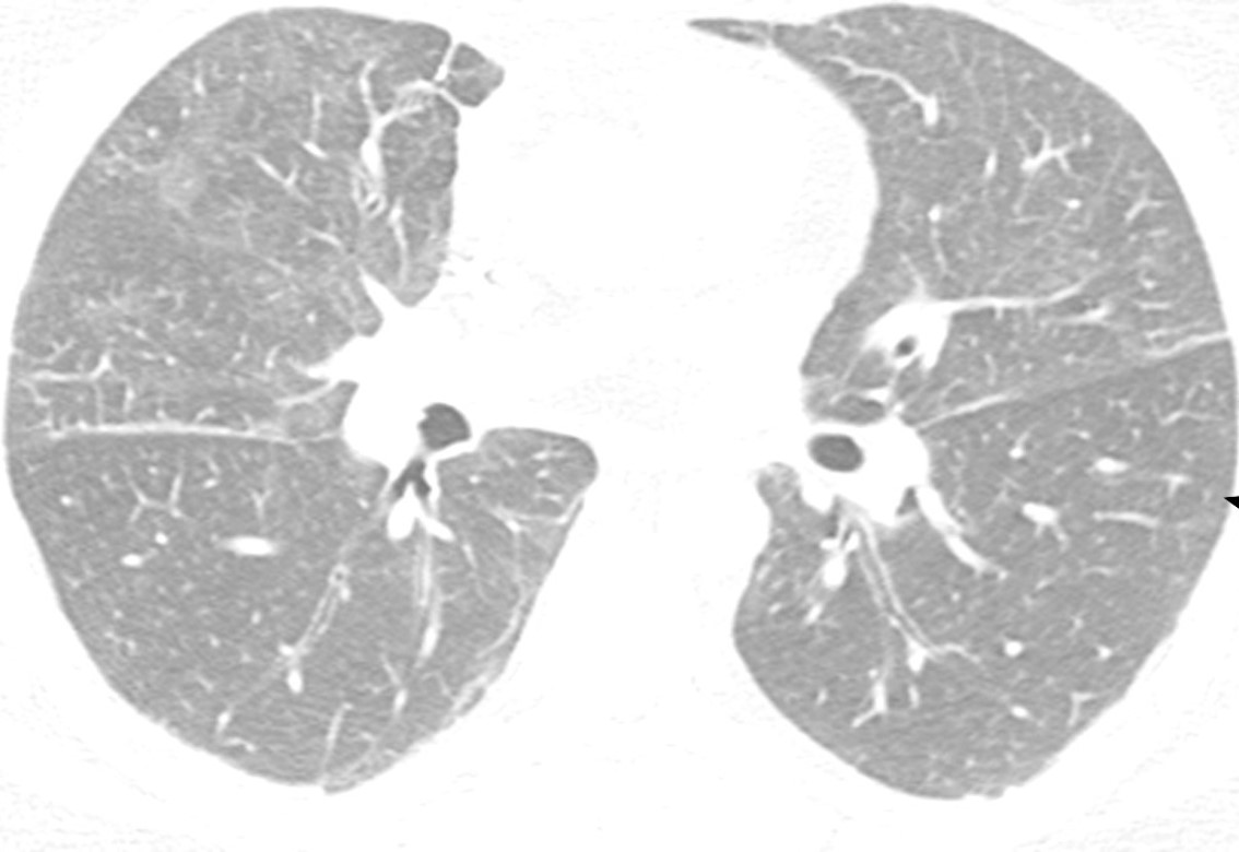 Extensive ground-glass abnormalities