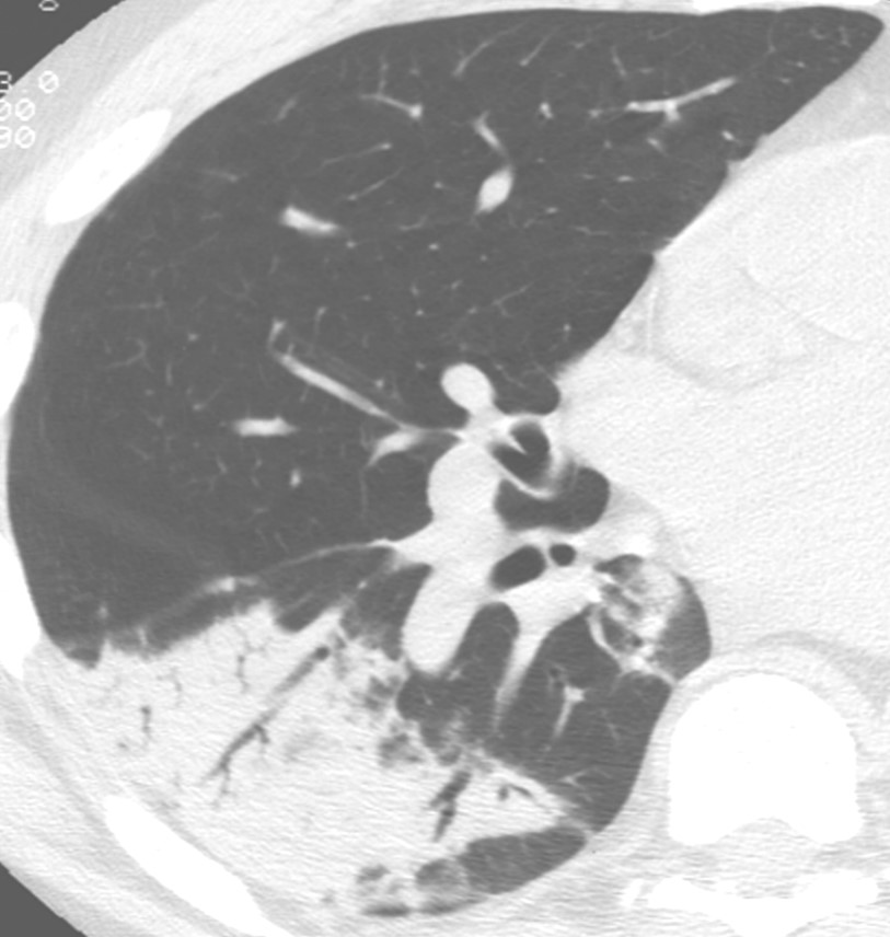 Consolidation in bronchopulmonary segment(s)/lobe(s)