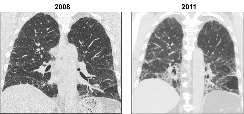 sagittal HRCT images