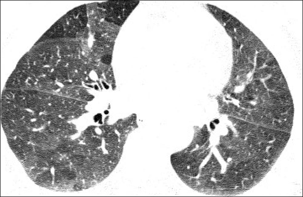 Ground Glass Opacity