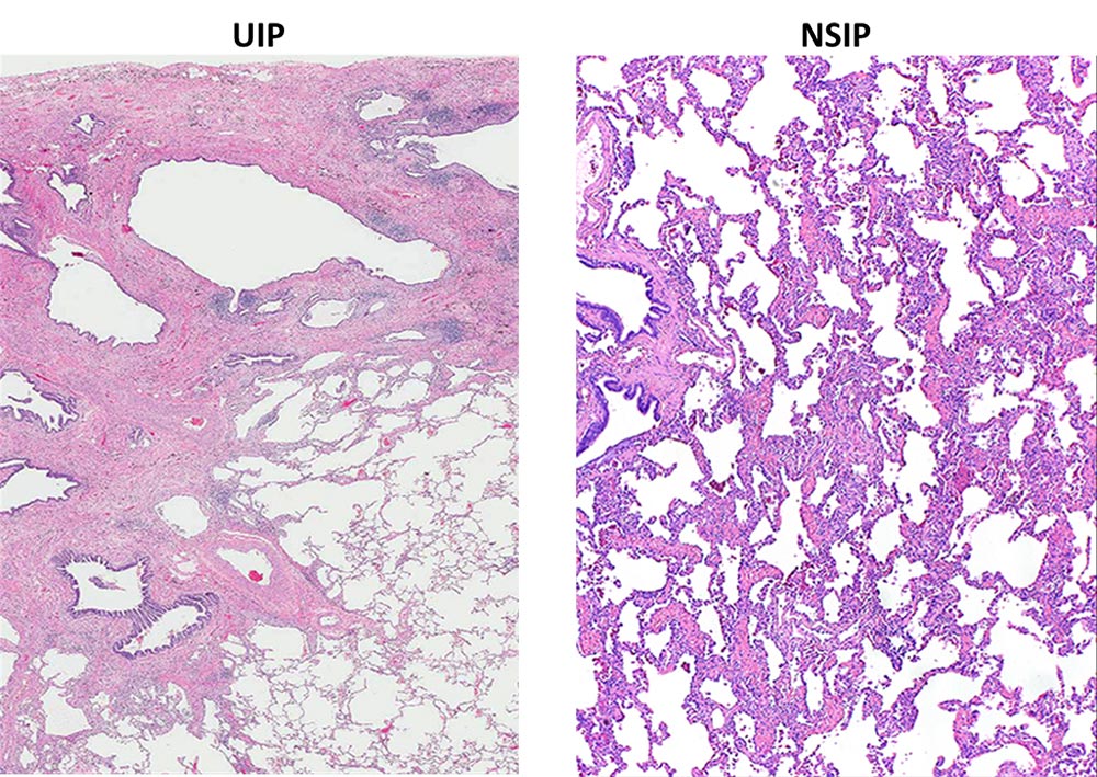 UIP and  NSIP comparison