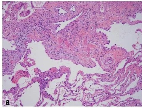 Histopathologic features of usual interstitial pneumonia