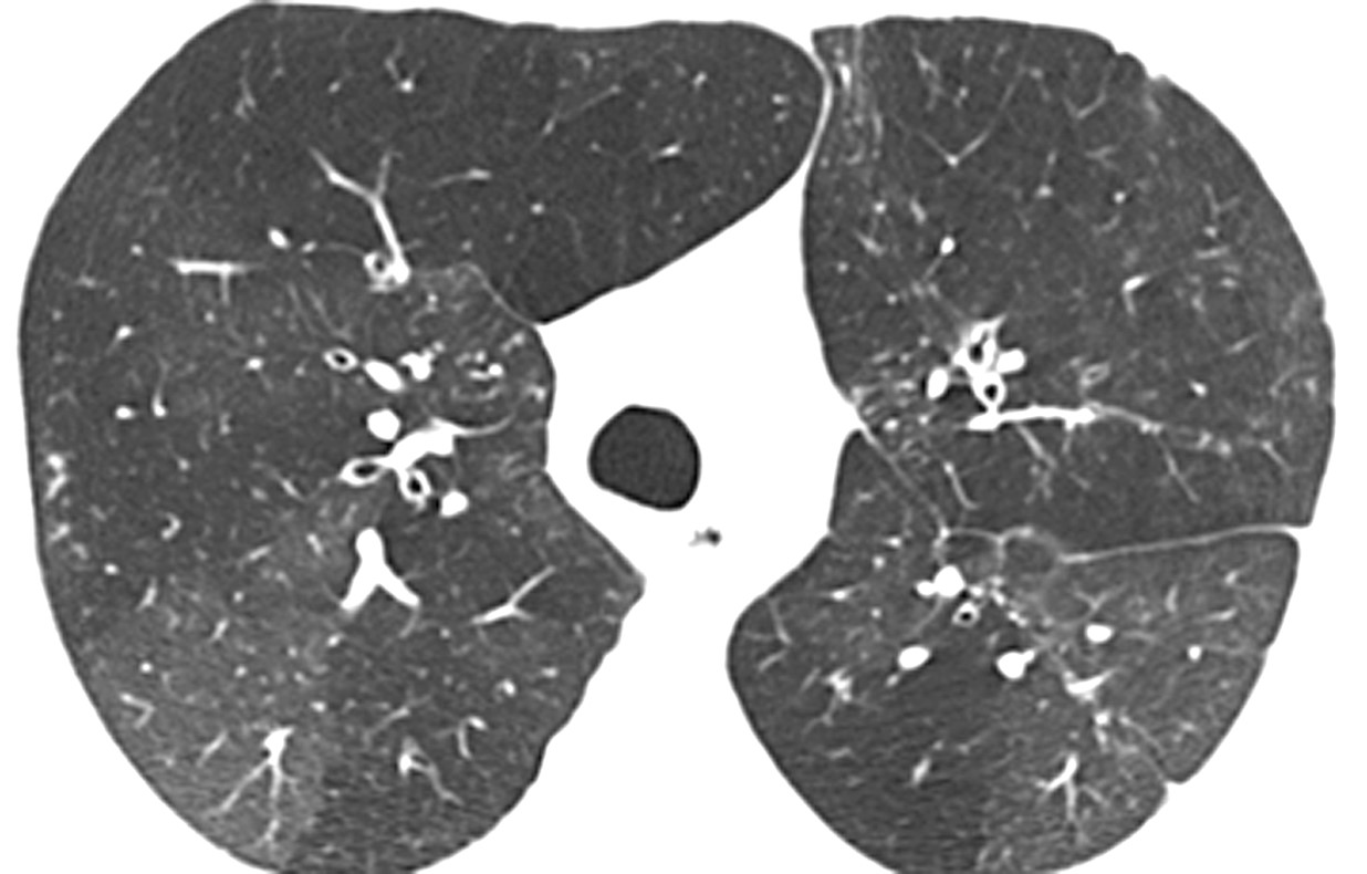 Diffuse mosaic attenuation/air trapping