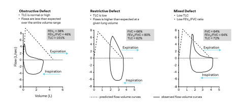 Pulmonary Function Test Patterns For Obstructive, Restrictive, And Mixed Lung Diseases